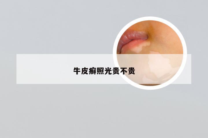 牛皮癣照光贵不贵
