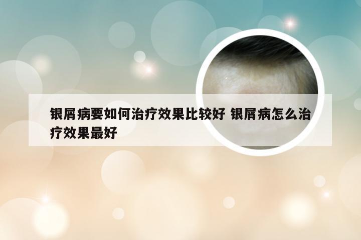 银屑病要如何治疗效果比较好 银屑病怎么治疗效果最好