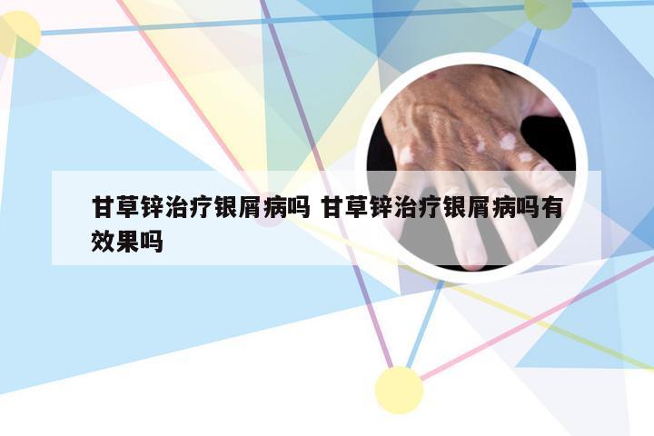 甘草锌治疗银屑病吗 甘草锌治疗银屑病吗有效果吗