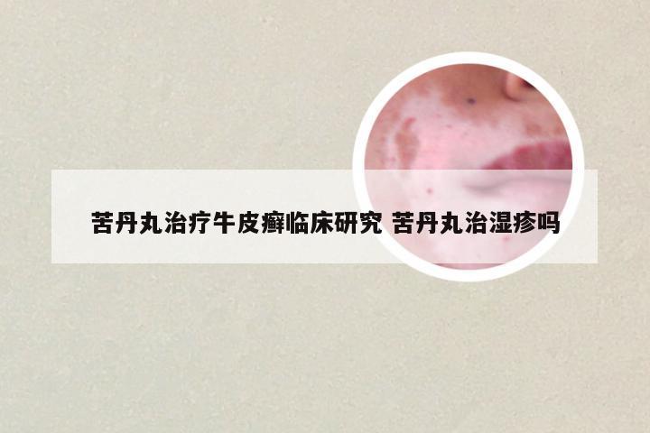 苦丹丸治疗牛皮癣临床研究 苦丹丸治湿疹吗