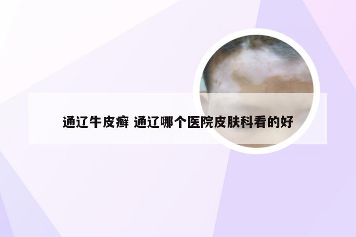 通辽牛皮癣 通辽哪个医院皮肤科看的好