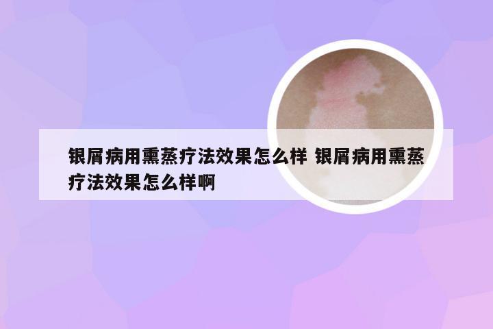 银屑病用熏蒸疗法效果怎么样 银屑病用熏蒸疗法效果怎么样啊