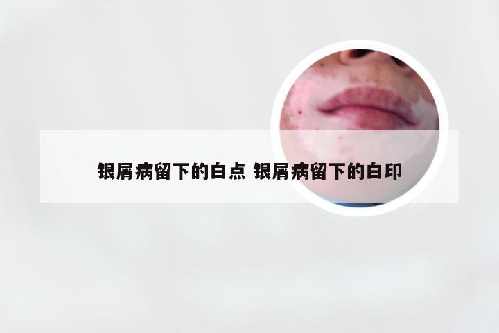 银屑病留下的白点 银屑病留下的白印