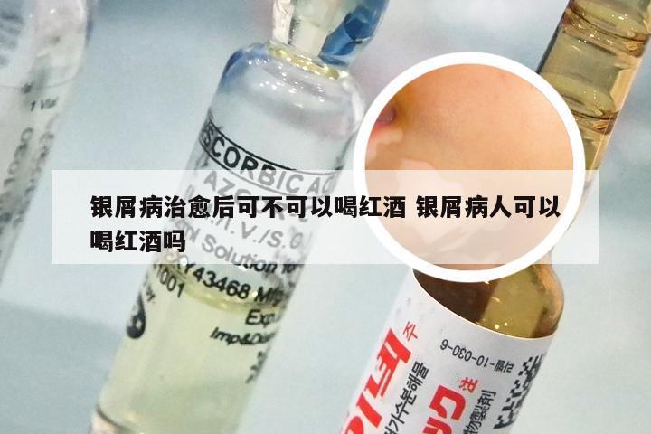 银屑病治愈后可不可以喝红酒 银屑病人可以喝红酒吗