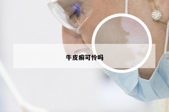 牛皮癣可怜吗