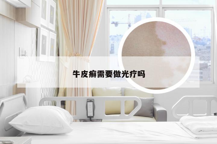牛皮癣需要做光疗吗