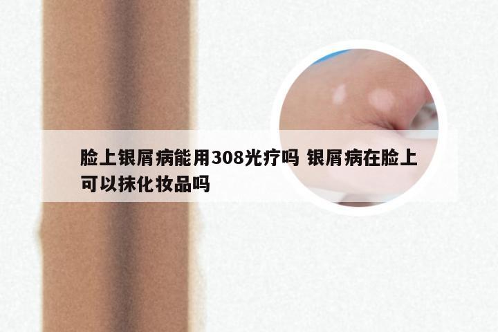 脸上银屑病能用308光疗吗 银屑病在脸上可以抹化妆品吗