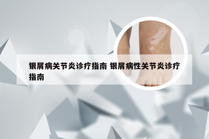 银屑病关节炎诊疗指南 银屑病性关节炎诊疗指南