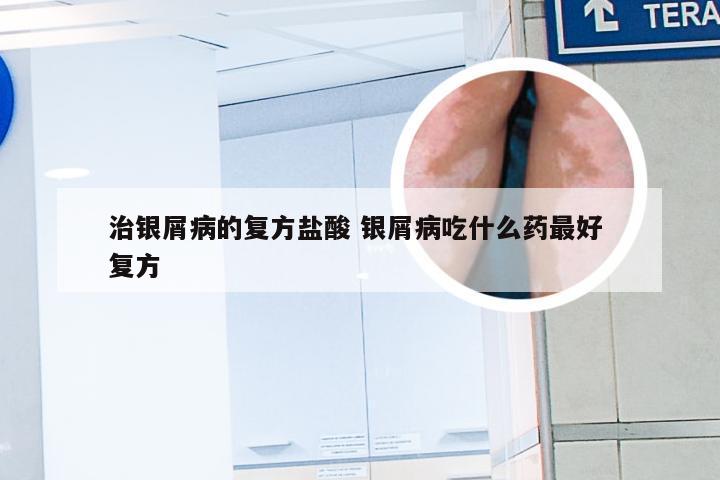 治银屑病的复方盐酸 银屑病吃什么药最好 复方