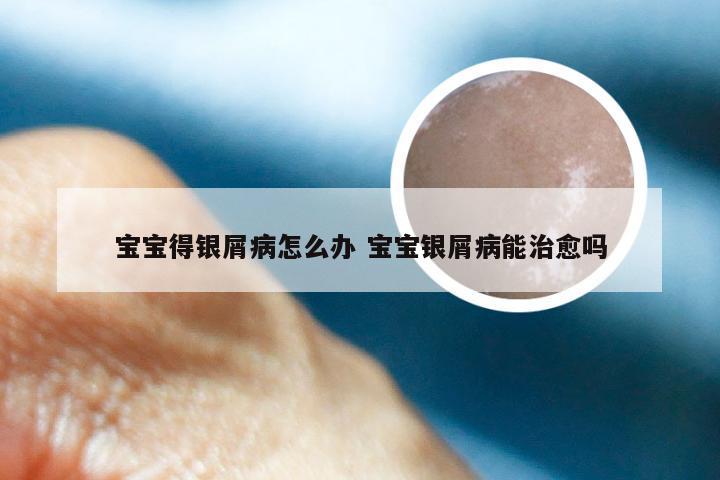 宝宝得银屑病怎么办 宝宝银屑病能治愈吗