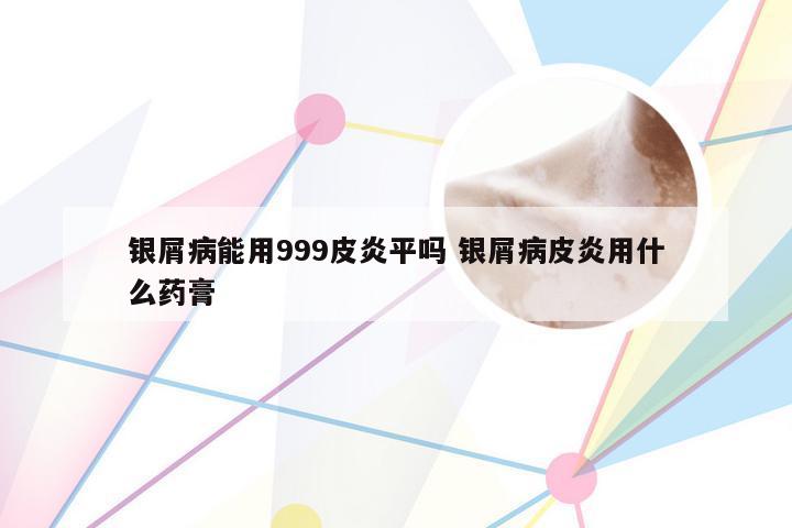 银屑病能用999皮炎平吗 银屑病皮炎用什么药膏