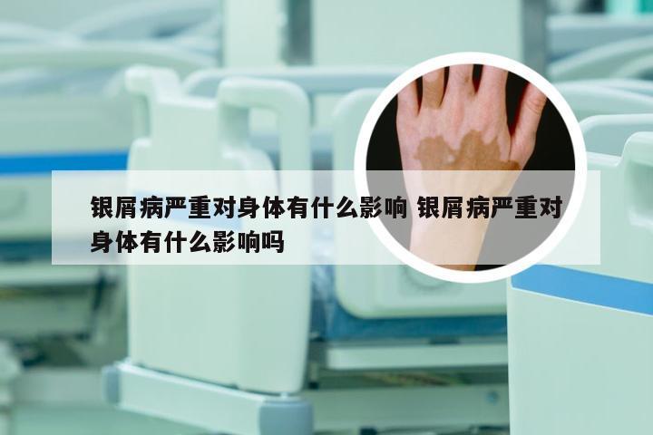 银屑病严重对身体有什么影响 银屑病严重对身体有什么影响吗