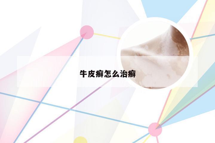 牛皮癣怎么治癣