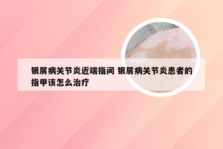 银屑病关节炎近端指间 银屑病关节炎患者的指甲该怎么治疗