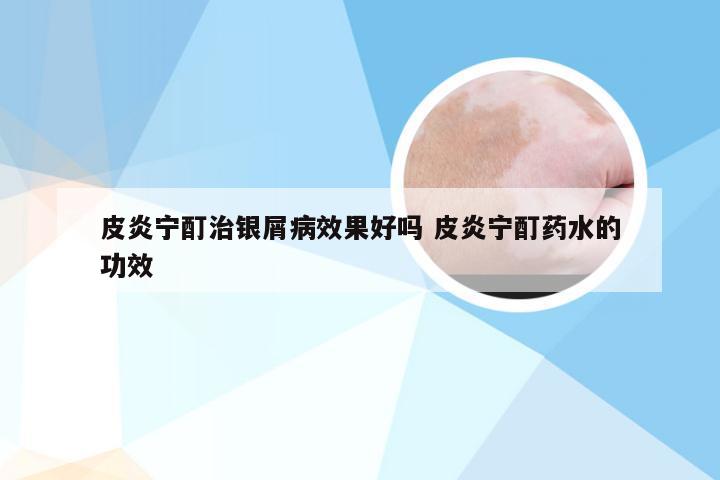 皮炎宁酊治银屑病效果好吗 皮炎宁酊药水的功效
