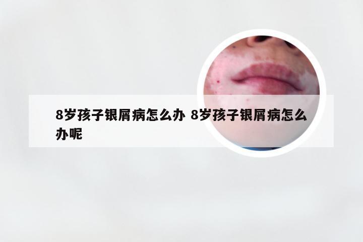 8岁孩子银屑病怎么办 8岁孩子银屑病怎么办呢