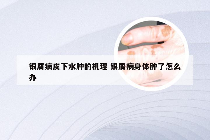 银屑病皮下水肿的机理 银屑病身体肿了怎么办