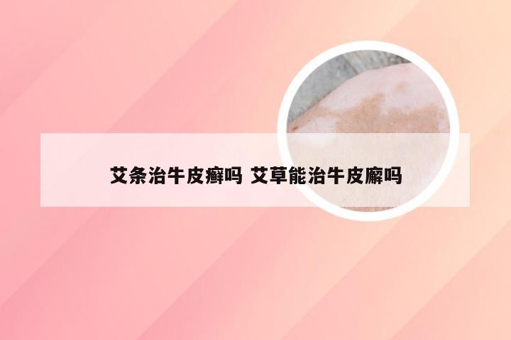 艾条治牛皮癣吗 艾草能治牛皮廨吗