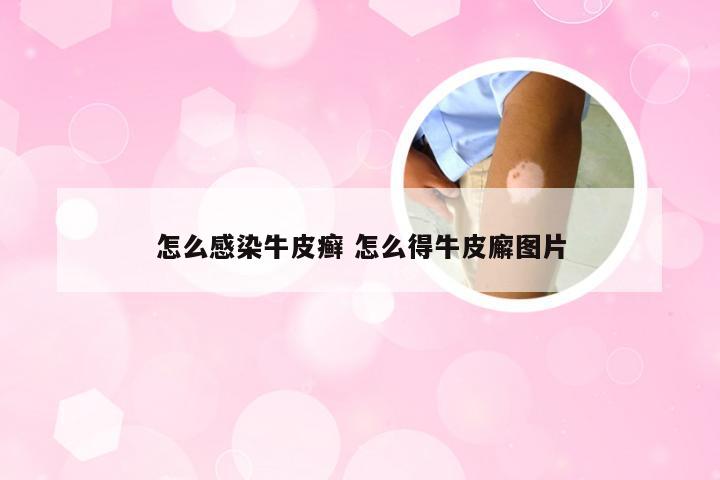 怎么感染牛皮癣 怎么得牛皮廨图片