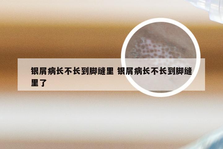 银屑病长不长到脚缝里 银屑病长不长到脚缝里了