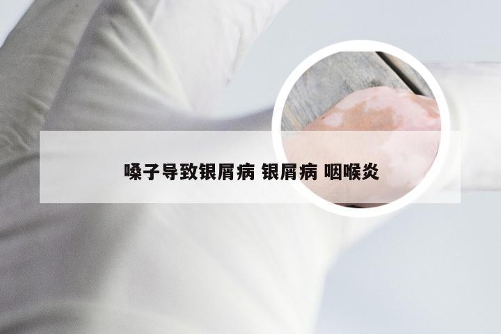 嗓子导致银屑病 银屑病 咽喉炎