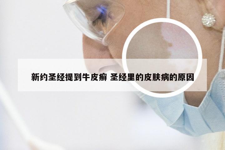 新约圣经提到牛皮癣 圣经里的皮肤病的原因