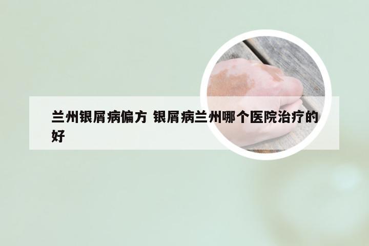 兰州银屑病偏方 银屑病兰州哪个医院治疗的好