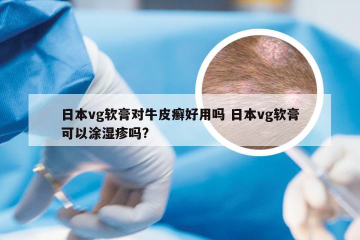 日本vg软膏对牛皮癣好用吗 日本vg软膏可以涂湿疹吗?