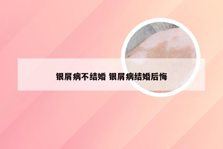 银屑病不结婚 银屑病结婚后悔