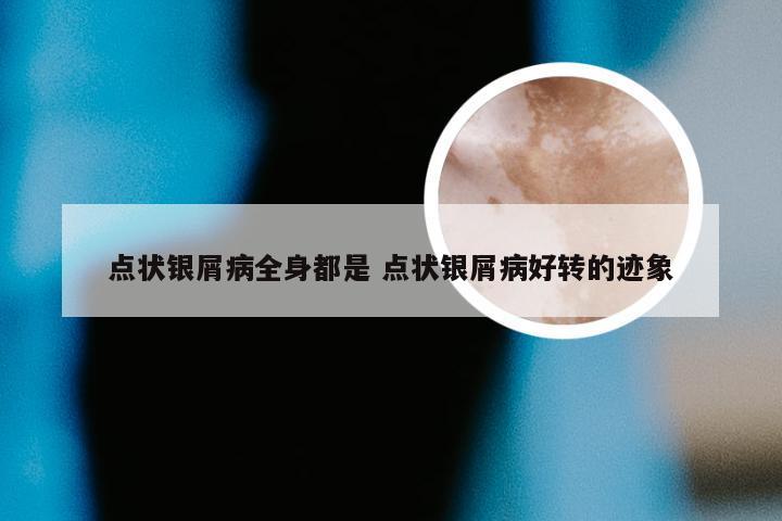 点状银屑病全身都是 点状银屑病好转的迹象
