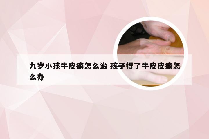 九岁小孩牛皮癣怎么治 孩子得了牛皮皮癣怎么办