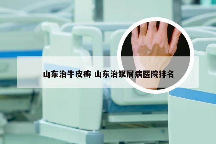 山东治牛皮癣 山东治银屑病医院排名