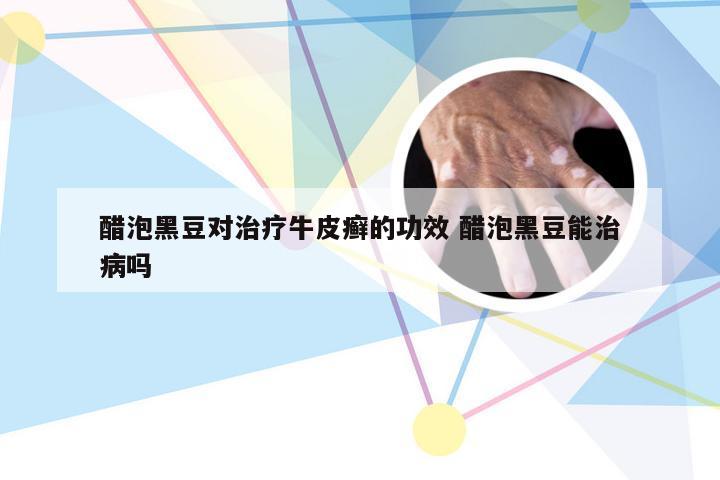 醋泡黑豆对治疗牛皮癣的功效 醋泡黑豆能治病吗
