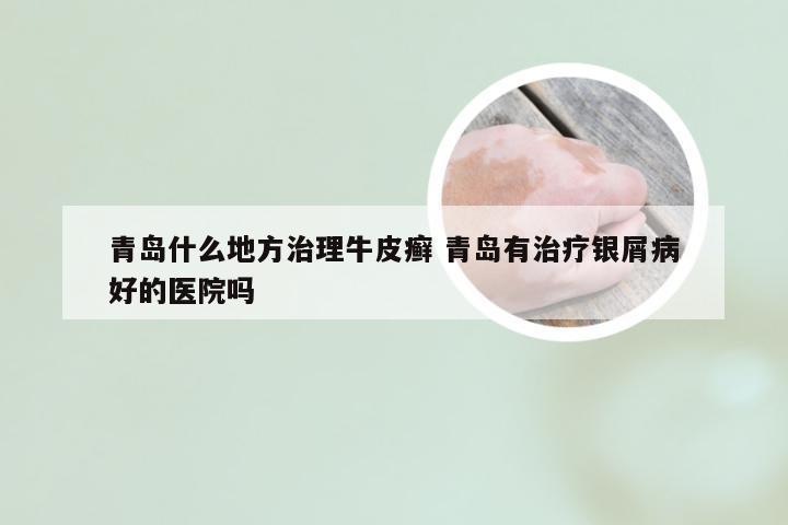 青岛什么地方治理牛皮癣 青岛有治疗银屑病好的医院吗
