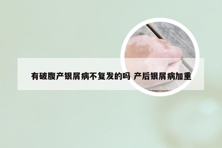 有破腹产银屑病不复发的吗 产后银屑病加重