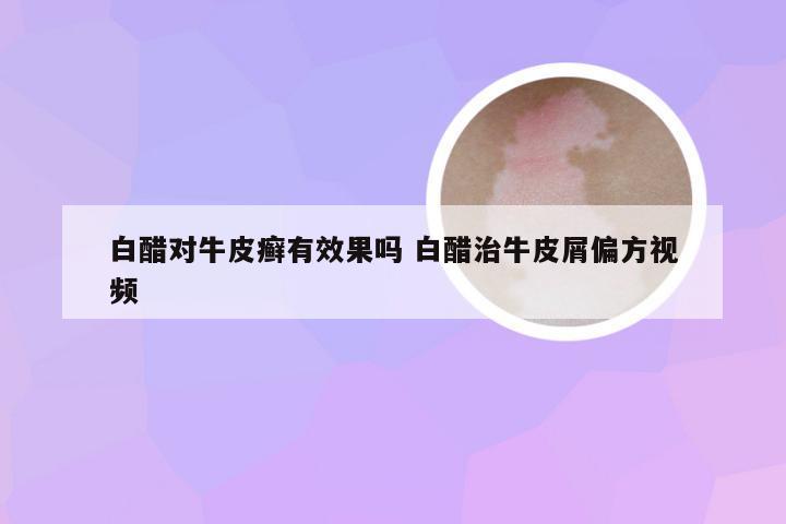白醋对牛皮癣有效果吗 白醋治牛皮屑偏方视频