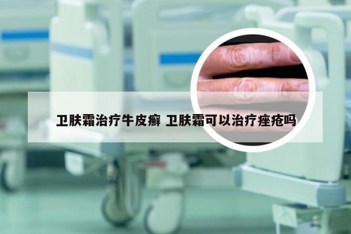卫肤霜治疗牛皮癣 卫肤霜可以治疗痤疮吗