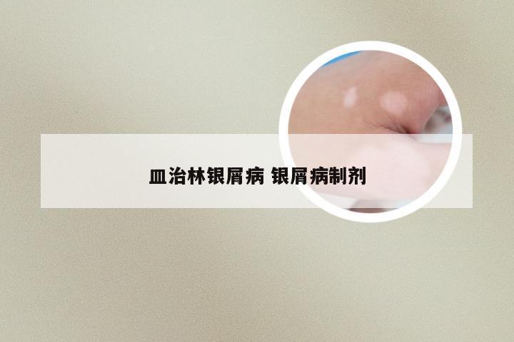 皿治林银屑病 银屑病制剂