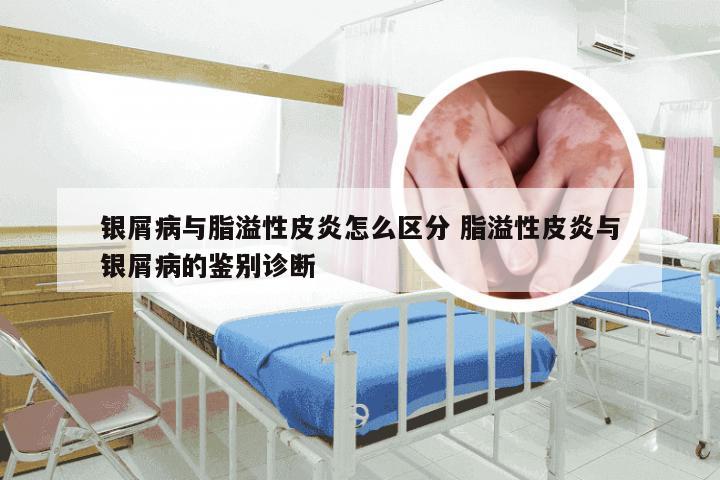 银屑病与脂溢性皮炎怎么区分 脂溢性皮炎与银屑病的鉴别诊断