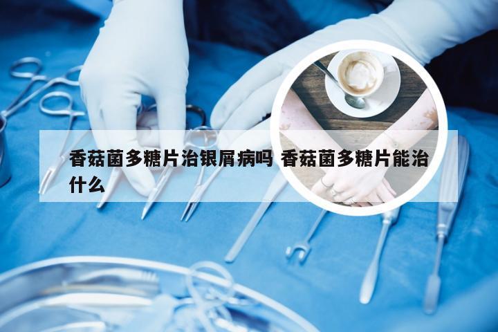 香菇菌多糖片治银屑病吗 香菇菌多糖片能治什么