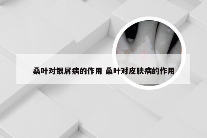 桑叶对银屑病的作用 桑叶对皮肤病的作用
