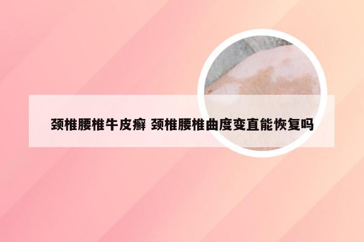 颈椎腰椎牛皮癣 颈椎腰椎曲度变直能恢复吗