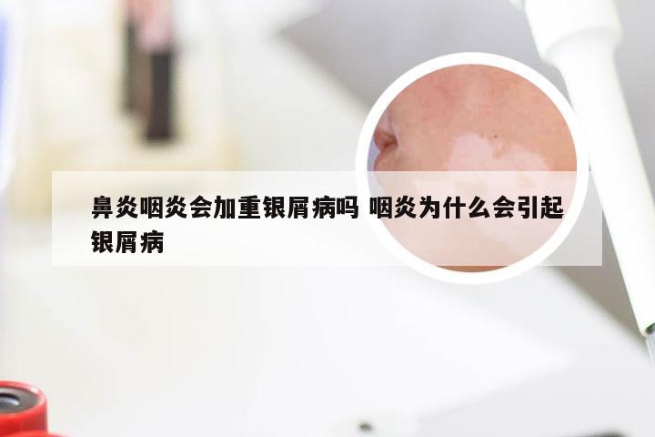 鼻炎咽炎会加重银屑病吗 咽炎为什么会引起银屑病