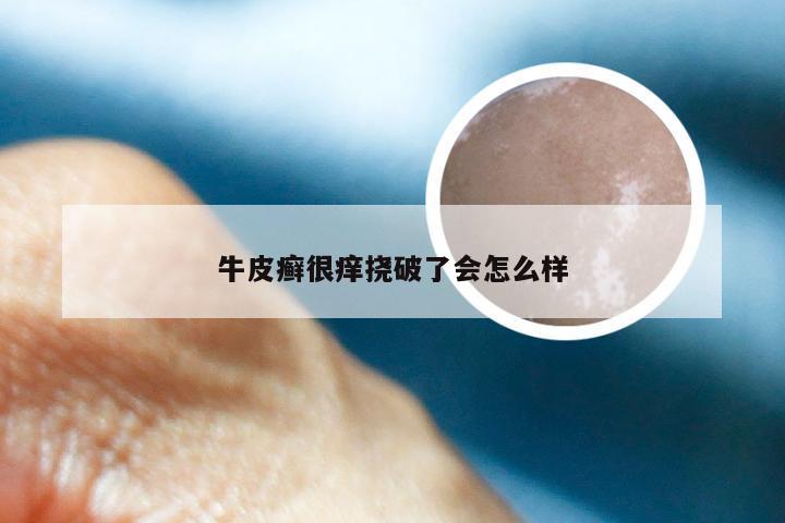 牛皮癣很痒挠破了会怎么样
