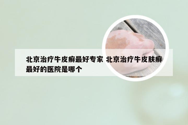 北京治疗牛皮癣最好专家 北京治疗牛皮肤癣最好的医院是哪个