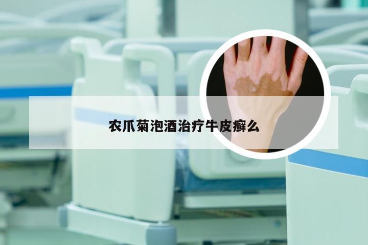 农爪菊泡酒治疗牛皮癣么