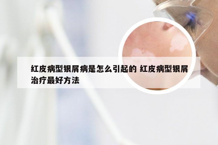 红皮病型银屑病是怎么引起的 红皮病型银屑治疗最好方法