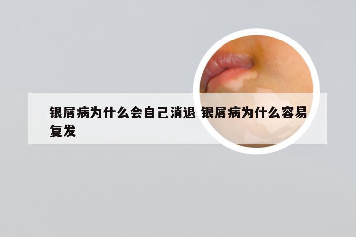银屑病为什么会自己消退 银屑病为什么容易复发