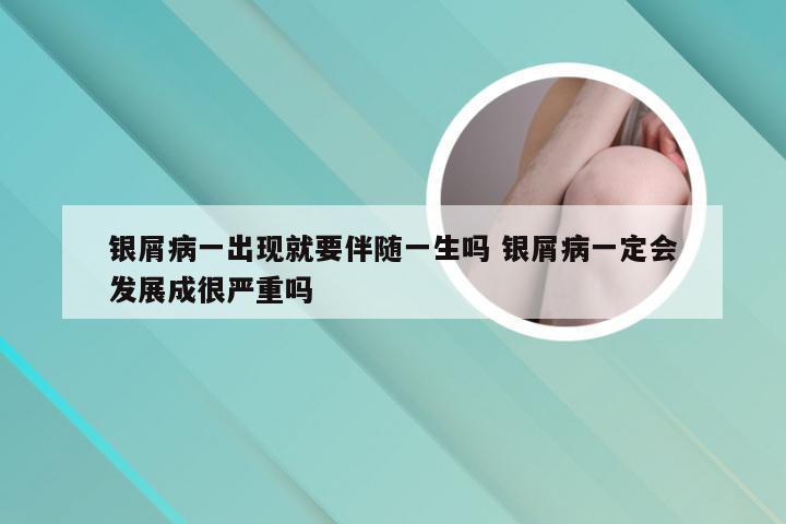 银屑病一出现就要伴随一生吗 银屑病一定会发展成很严重吗