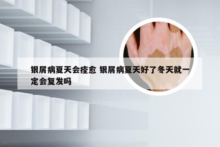 银屑病夏天会痊愈 银屑病夏天好了冬天就一定会复发吗